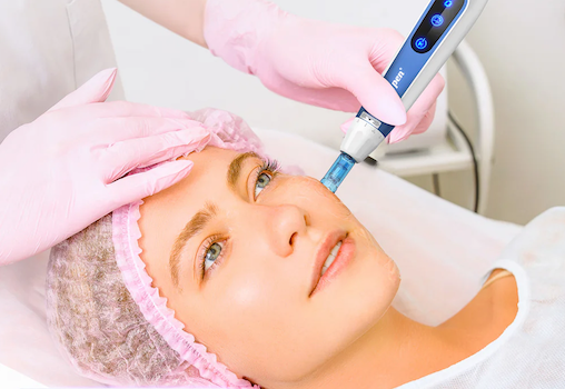Μεσοθεραπεία Dermapen