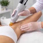Πόνος στη Laser Αποτρίχωση: Πόσο Πονάει και Πώς το Μειώνουμε